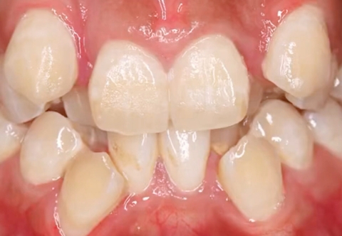 Niềng Răng Khấp Khểnh Bao Nhiêu Tiền 